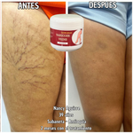 ¡OFERTA 2 x 1! VARICOSE VEINS PROFESIONAL (ORIGINAL) – Recupera la Belleza y Ligereza de Tus Piernas