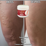 ¡OFERTA 2 x 1! VARICOSE VEINS PROFESIONAL (ORIGINAL) – Recupera la Belleza y Ligereza de Tus Piernas
