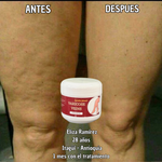 ¡OFERTA 2 x 1! VARICOSE VEINS PROFESIONAL (ORIGINAL) – Recupera la Belleza y Ligereza de Tus Piernas
