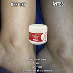 ¡OFERTA 2 x 1! VARICOSE VEINS PROFESIONAL (ORIGINAL) – Recupera la Belleza y Ligereza de Tus Piernas