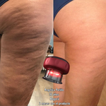 SMART CUPPING PRO™ Masajeador Inteligente de Bienestar y Cuidado Corporal