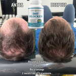 DHT BLOCKER 60 Capsulas - Actúa ahora antes de que la caída de tu cabello avance.