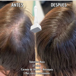 Derma Stamp – Activa Colágeno y Reactiva tu Cabello - Terapia Microagujas