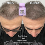 Lemme Grow Original® – Suplemento Capilar Oficial de la Marca de las Kardashian | Crecimiento y Fortalecimiento del Cabello
