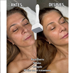 Derma Stamp – Activa Colágeno y Reactiva tu Cabello - Terapia Microagujas