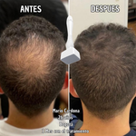 Derma Stamp – Activa Colágeno y Reactiva tu Cabello - Terapia Microagujas