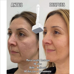Derma Stamp – Activa Colágeno y Reactiva tu Cabello - Terapia Microagujas